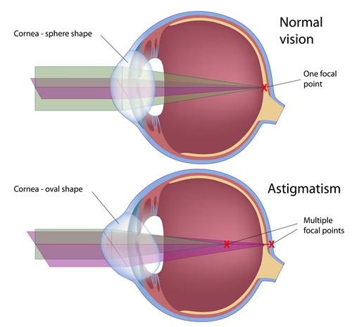 Eye with and without Astigmatism