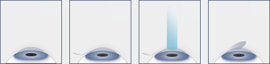 LASIK Eye Surgery procedure diagram