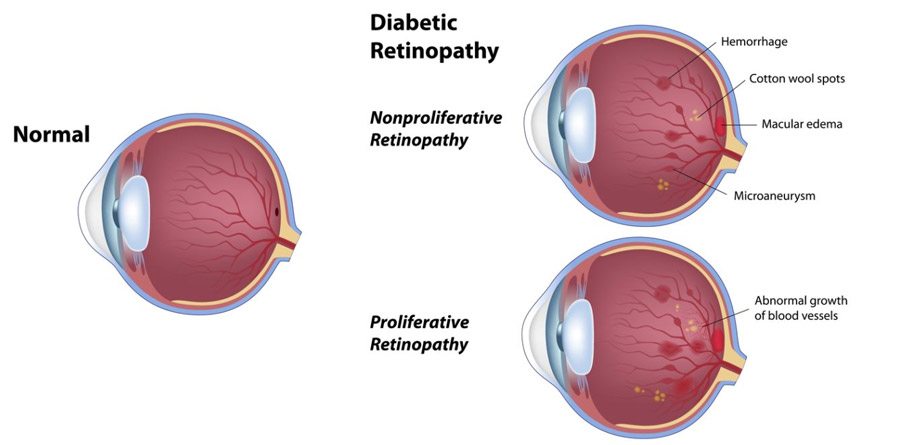 Diabetic Retinopathy Diagram 