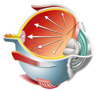 Glaucoma diagram 