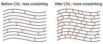 Before and after CXL diagram