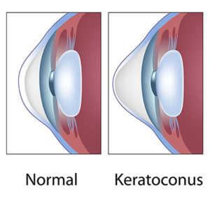 Normal eye compared to Keratoconus diagram