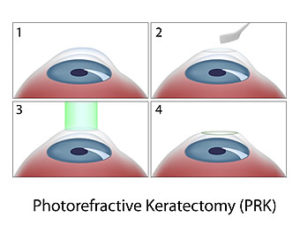 PRK Surgery Procedure diagram