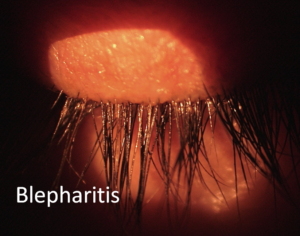 Blepharitis